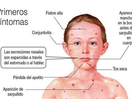 EE.UU. se acerca a su mayor número de casos de sarampión en más de 30 añosLuisiana confirma 8 casos en 2025, todos en personas no vacunadas