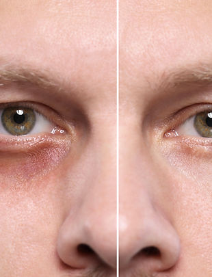 Collage with photos of man with dark circle under eye before and after treatment on beige