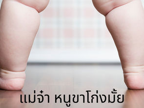 โรคขาโก่งในเด็กเล็ก ที่คุณพ่อ-คุณแม่ต้องทำความเข้าใจ