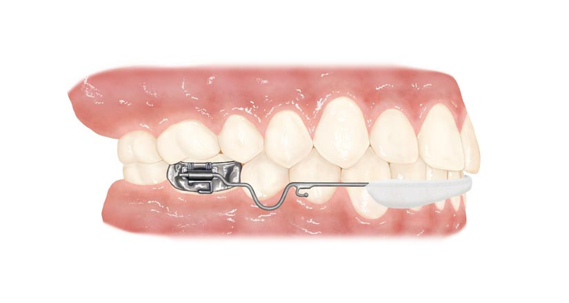 Como-funciona-el-Lip-Bumper