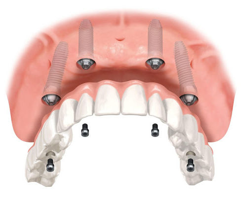 protesis-dental-en-monterrey