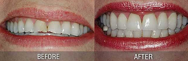 Smile Makeovers