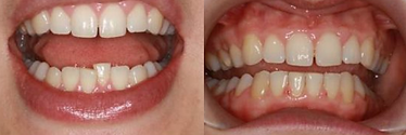 Braces
