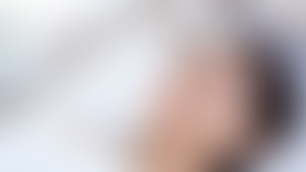Temple and Forehead Fillers: What to Know Before Treatment