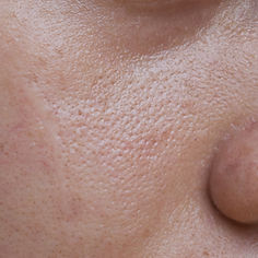 fair-skin-with-wide-pores-face-southeast-asian-myanmar-korean-adult-young-woman (1).jpg