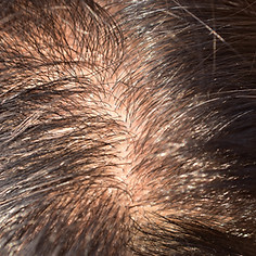 scalp-loosing-hair-alopecia-concept.jpg