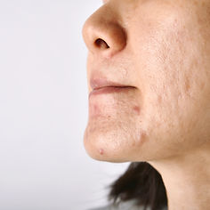 skin-problem-with-acne-diseases-scar-oily-greasy-face.jpg