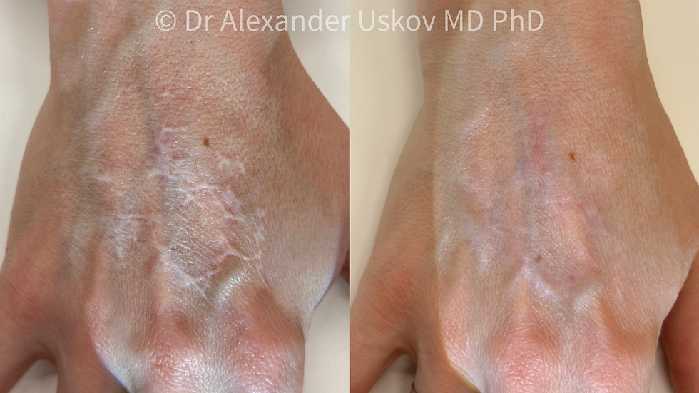 ندبة الحروق