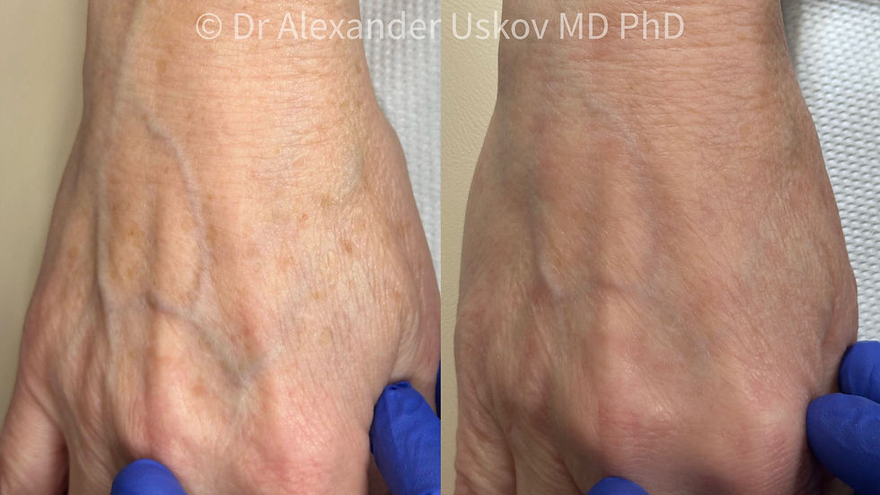 A before and after photo showing the back of the hand with pigment spots removed after laser treatment.
