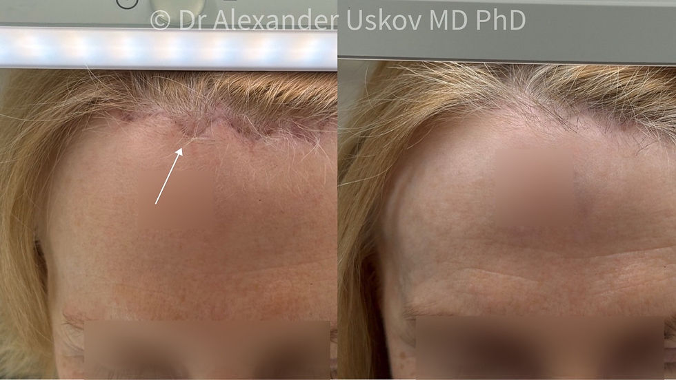 Before and after photos of the forehead: in the before image a scar is visible along the hairline. In the after image the scar is no longer visible and blends seamlessly with the hairline thanks to laser therapy.
