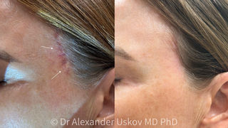 Before and after photo showing successful treatment of a red facelift scar along the hairline. In the before image a bright red, clearly visible scar is seen. In the after image the scar is barely noticeable and no longer red; its color matches the surrounding skin.