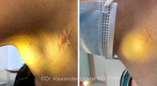 Foto „enne ja pärast“, mis näitab patsiendi kaela, kus sünnimärgi eemaldamise järel tekkinud arm on laserravi järel edukalt ravitud.