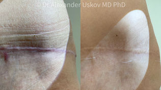 Foto „enne ja pärast“, mis demonstreerib keloidse armi laserravi suurepäraseid tulemusi.