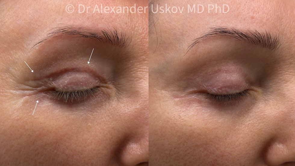 Narbe nach Oberlid-Blepharoplastik