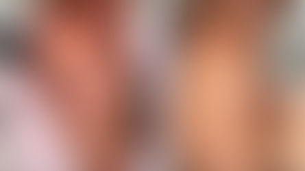 Pilt „enne ja pärast”: vasakul õlal on näha tätoveering. „Pärast” pildil ei ole tätoveering enam nähtav, sest lasereemalduskuur on pigmendi täielikult eemaldanud.