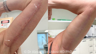 Фотография «до и после» лазерного удаления рубца на внутренней стороне руки женщины