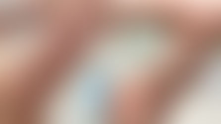 Foto „enne ja pärast“, mis näitab naise käsivarre siseküljel asuva armi lasereemalduse tulemust.