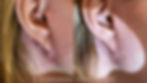 Before and after photo of the right ear with a facelift scar around the lower edge of the earlobe. In the after image the scar is much less noticeable and blends seamlessly with the surrounding skin.