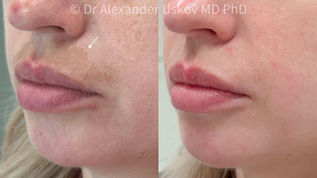 Фотографии до и после: область гиперпигментации над верхней губой у женщины, успешно пролеченная лазером