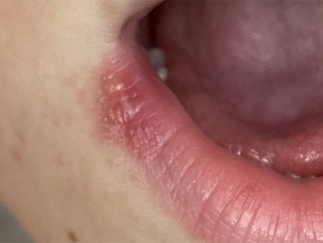 Herpes em crianças: o que os pais precisam saber