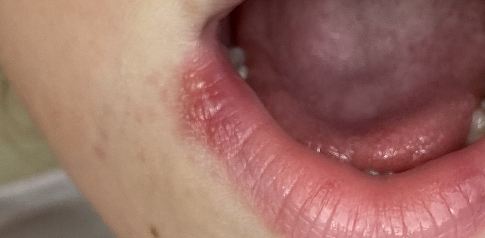 Herpes em crianças: o que os pais precisam saber