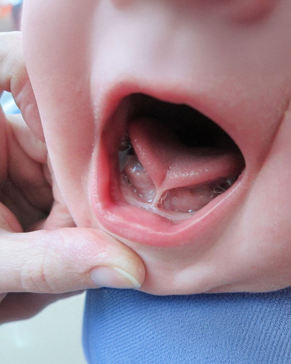 Freio lingual curto: como pode interferir na amamentação, respiração e dentição do bebê?