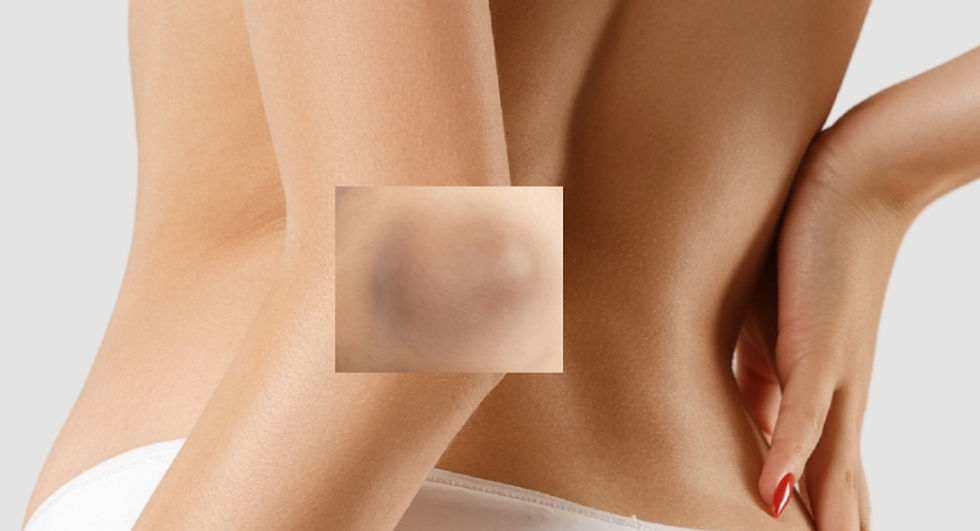 Peeling Químico, Medicina Estética Corporal: Para uniformizar o tom e suavizar a pele espessada/escurecida, incluindo axilas, cotovelos e joelhos.