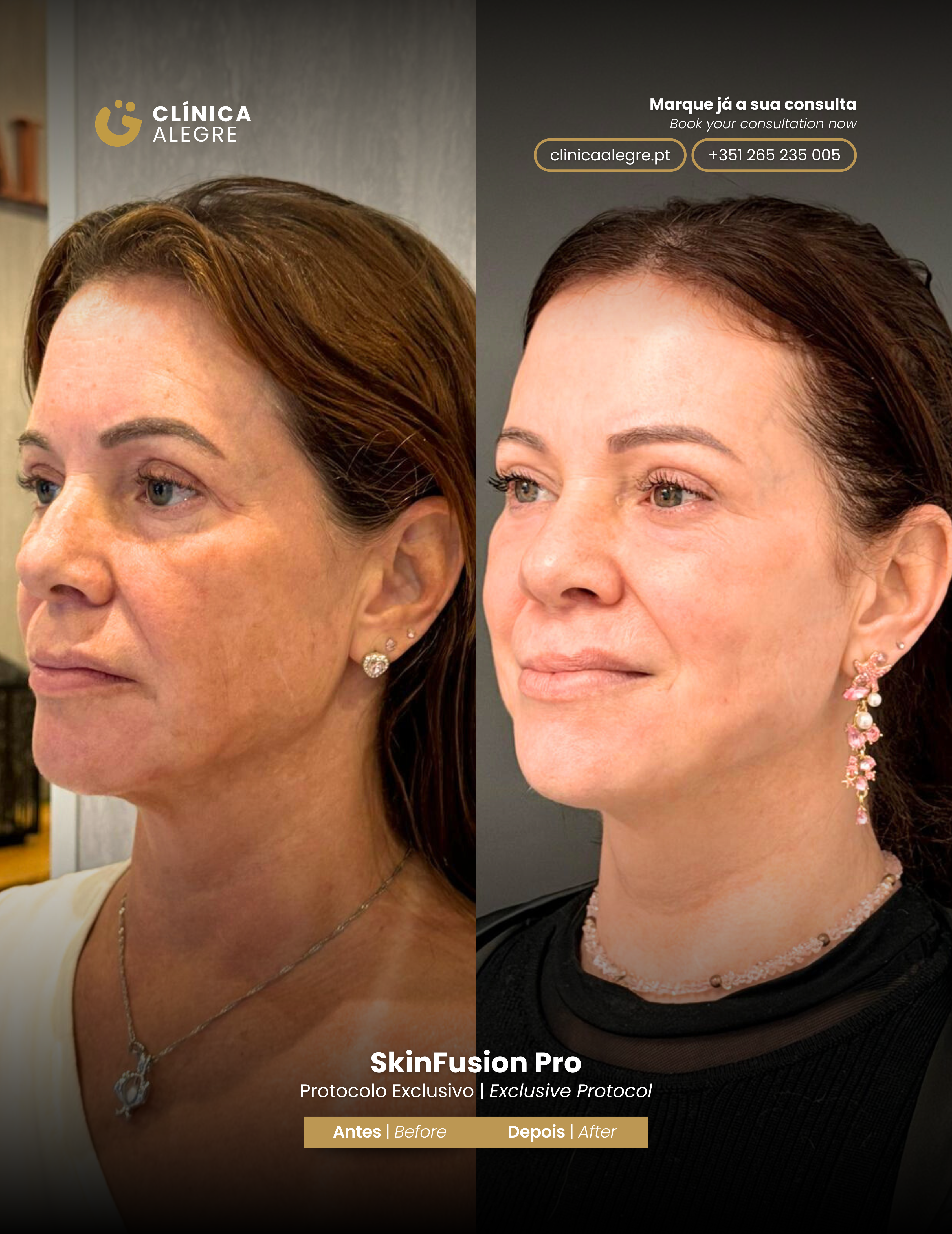 Antes e Depois Skinfusion Pro