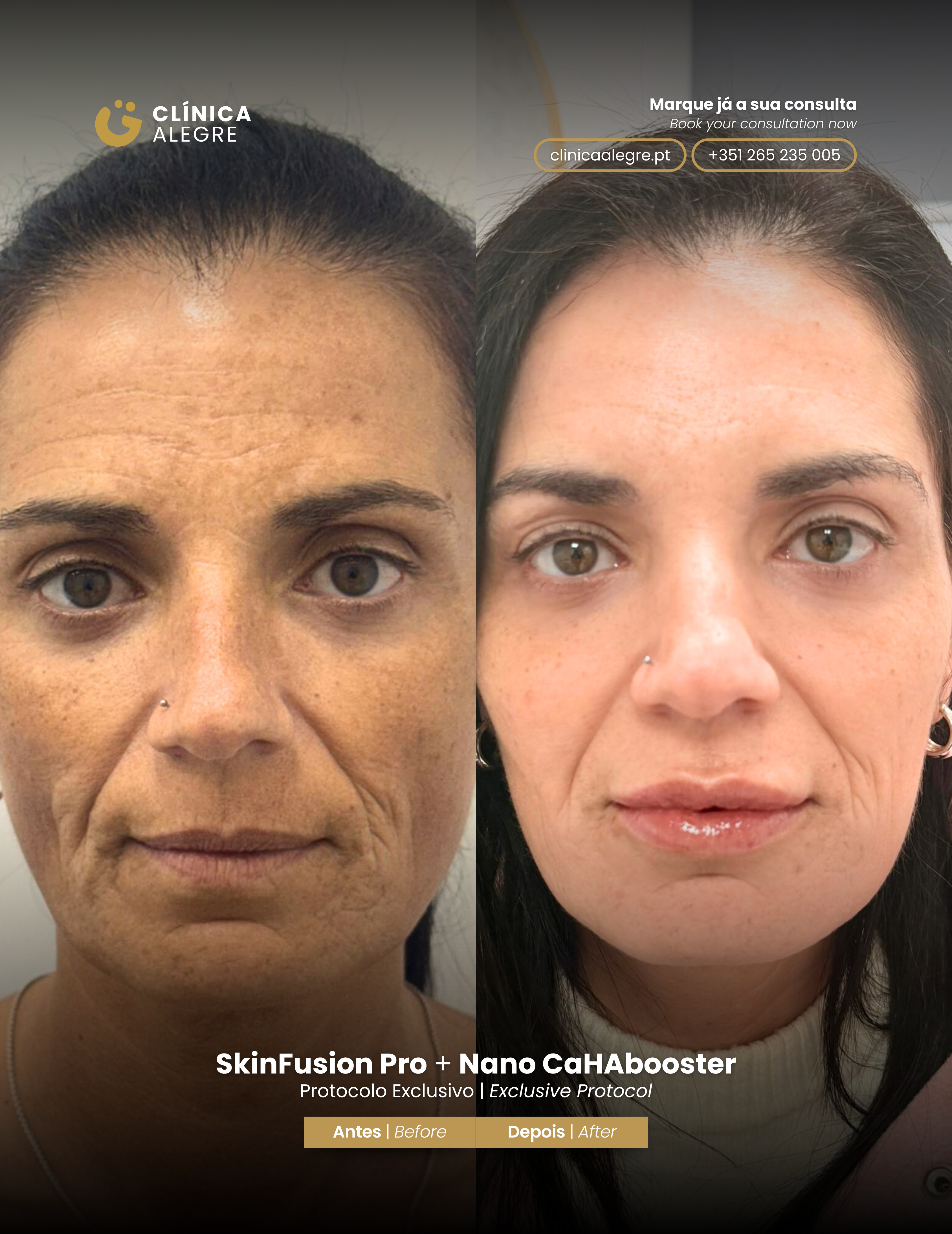 Antes e Depois Skinfusion Pro