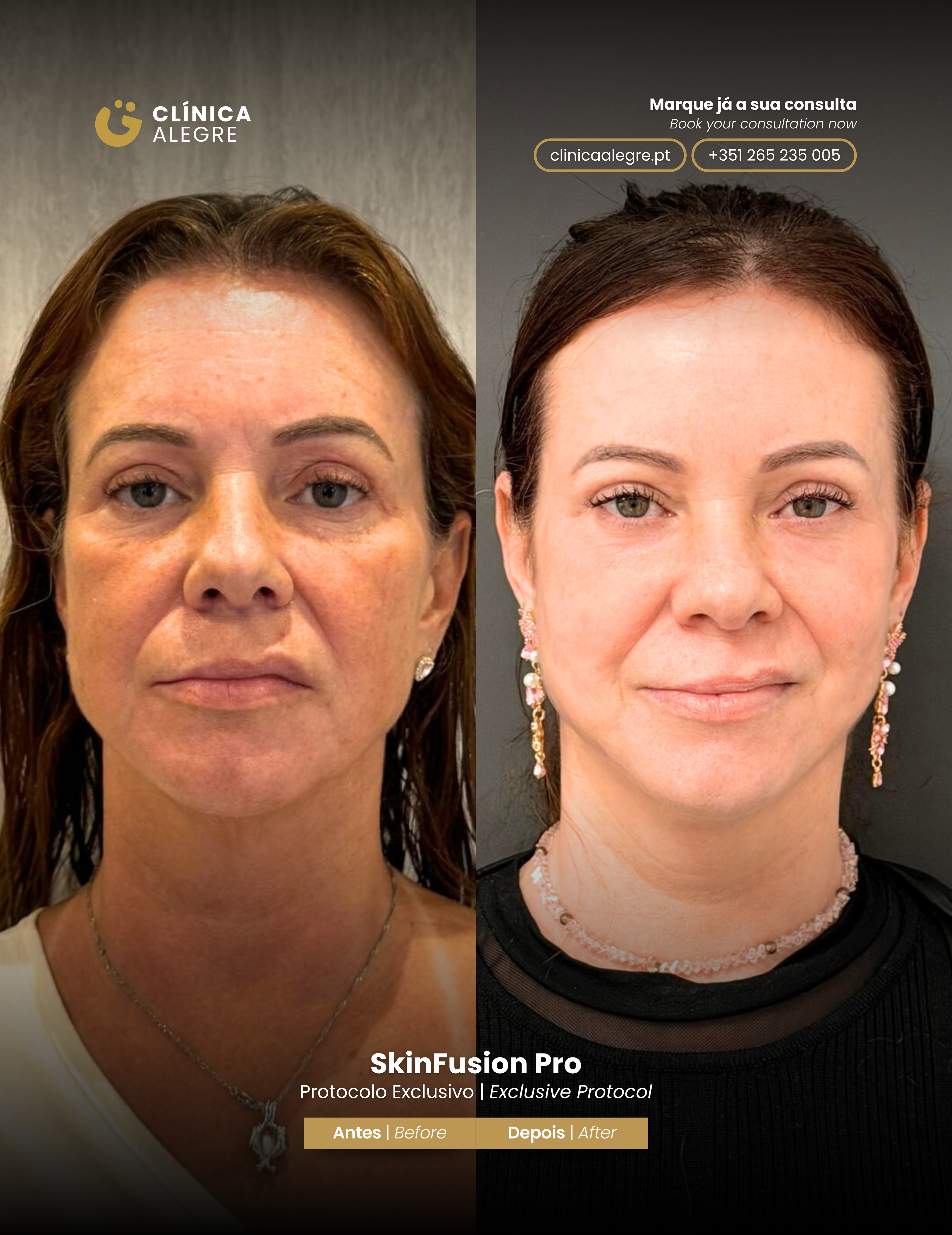 Antes e Depois Skinfusion Pro