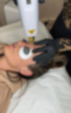 Tattoo Removal - Luxe Brows Surrey