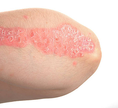 psoriasis.jpg