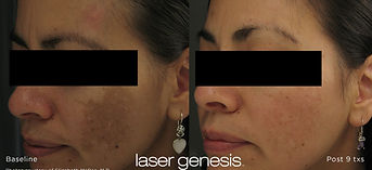 xeo_lasergenesis_1 (2).jpg