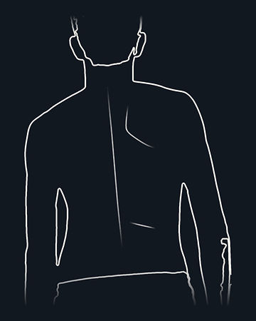 Line drawing of a patient's back with a slight spinal curve, for scoliosis observation