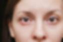 Painful Bumpy Stye on an Eyelid.jpg
