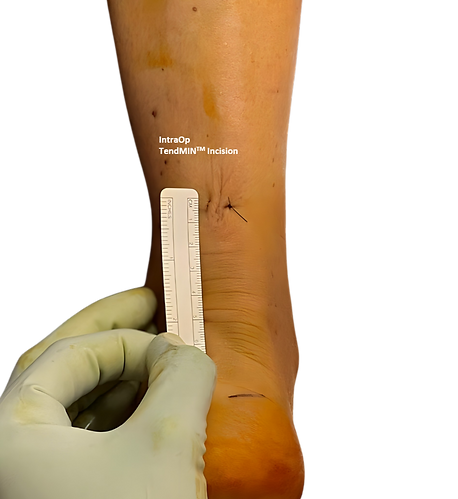 Intra-Op Incision_edited.png