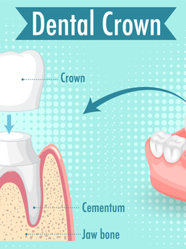 Dental Crowns