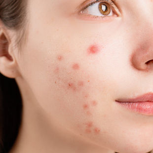 Targeted Skincare: Acne-Prone Skin