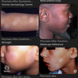 White Spots on Face