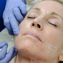 PDO thread Lift Training