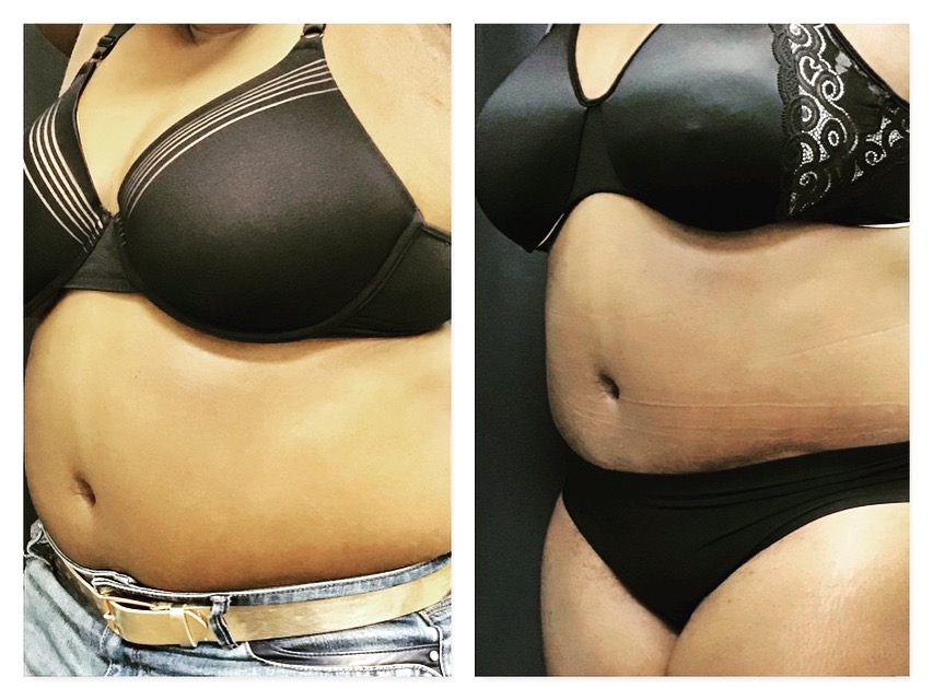 Sculpsre abdomen