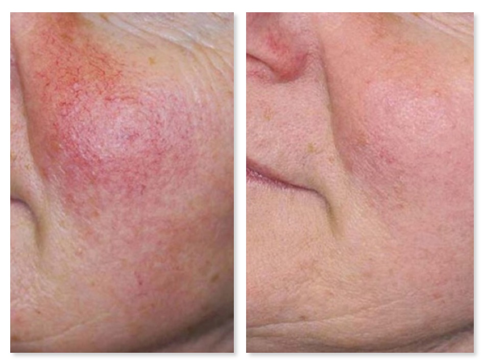 Icon facial vessels 'Reds'