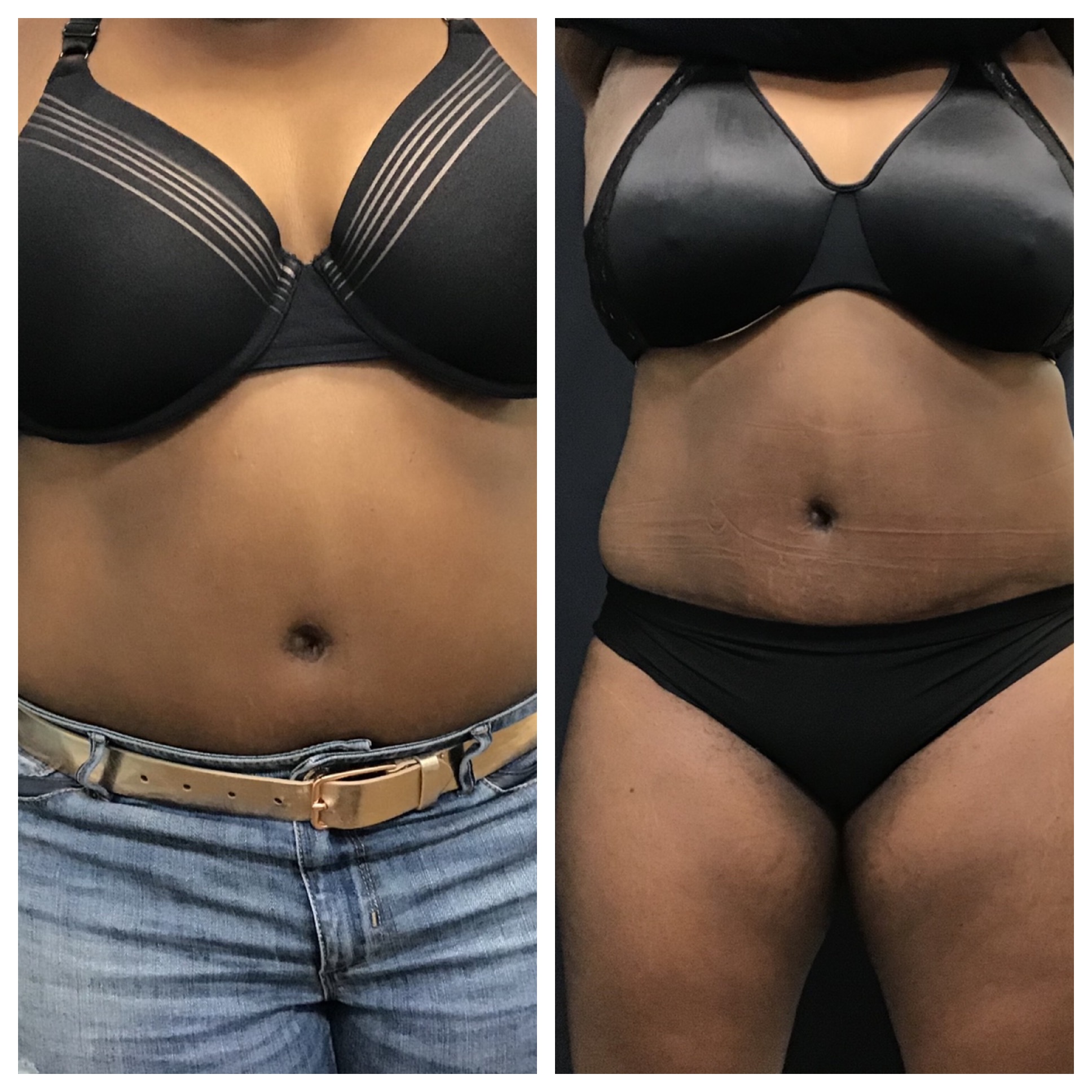 Sculpsure Abdomen