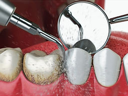 limpeza-dental-como-e-feita-sorocaba-dentista_edited.jpg