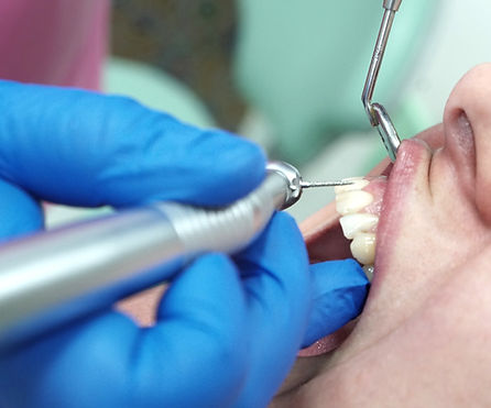shaving tooth for veneer_edited.jpg