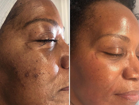 Safe Laser Treatments for Deep Skin Tones: Why the 650-Microsecond Technology is a Game Changer