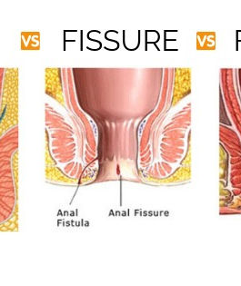 Modern Approaches to Piles and Fistula Treatment for Fast Relief