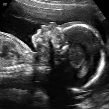 Traditional 2D ultrasound image capturing the profile of a developing baby, showcasing Prenatal Cinemas' dedication to provid