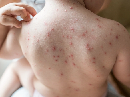 10 INTREBARI SI RASPUNSURI DESPRE VARICELA