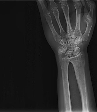 Radiografía Carpal